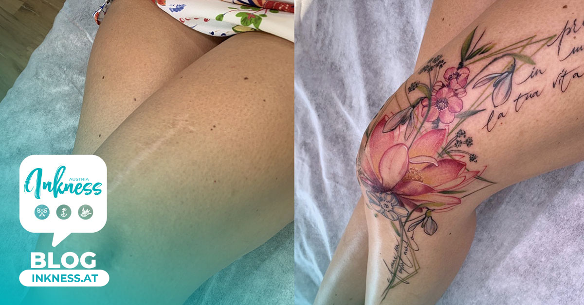 Bedecken Sie Ihre Narben mit einem Tattoo!